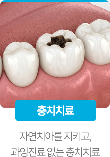 충치치료