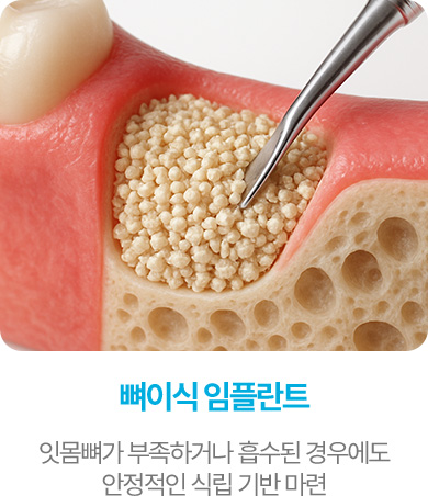 뼈이식 임플란트