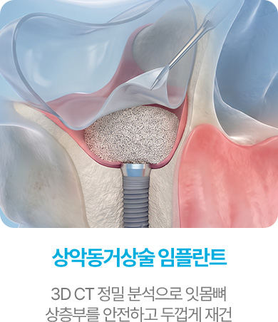 상악동거상술 임플란트