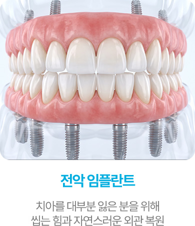 전악 임플란트