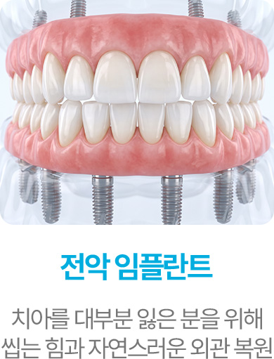 전악 임플란트